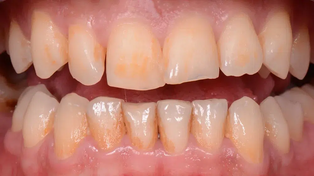 Clinica Dentária - BMQ Clinic | Guided Biofilm Therapy | 6598e9a255ab821f56c781a4 case 1