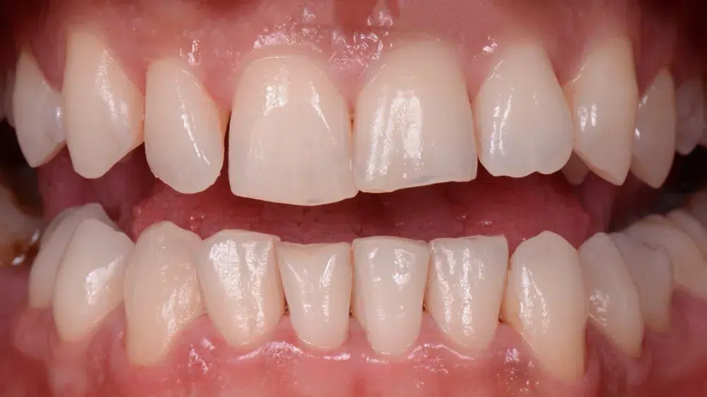 Clinica Dentária - BMQ Clinic | Guided Biofilm Therapy | 6598e9a32ee8d6c142bff1e1 case 1 1
