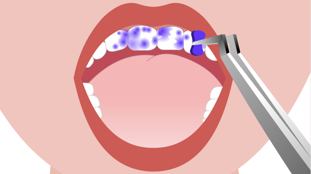 Clinica Dentária - BMQ Clinic | Guided Biofilm Therapy | gbt passo 2