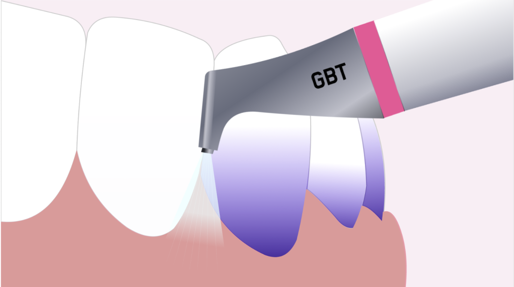 Clinica Dentária - BMQ Clinic | Guided Biofilm Therapy | gbt passo 4