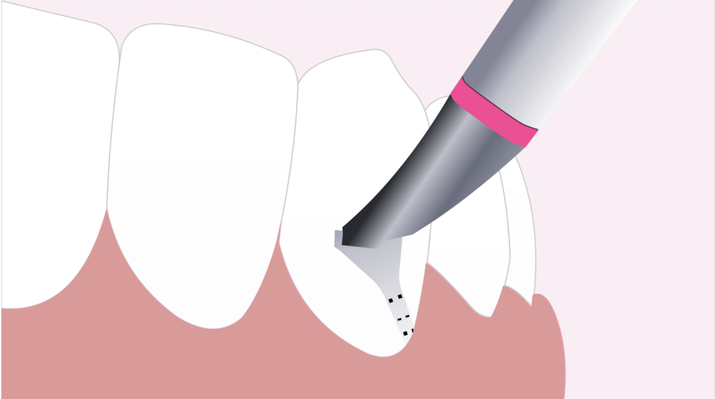 Clinica Dentária - BMQ Clinic | Guided Biofilm Therapy | gbt passo 5