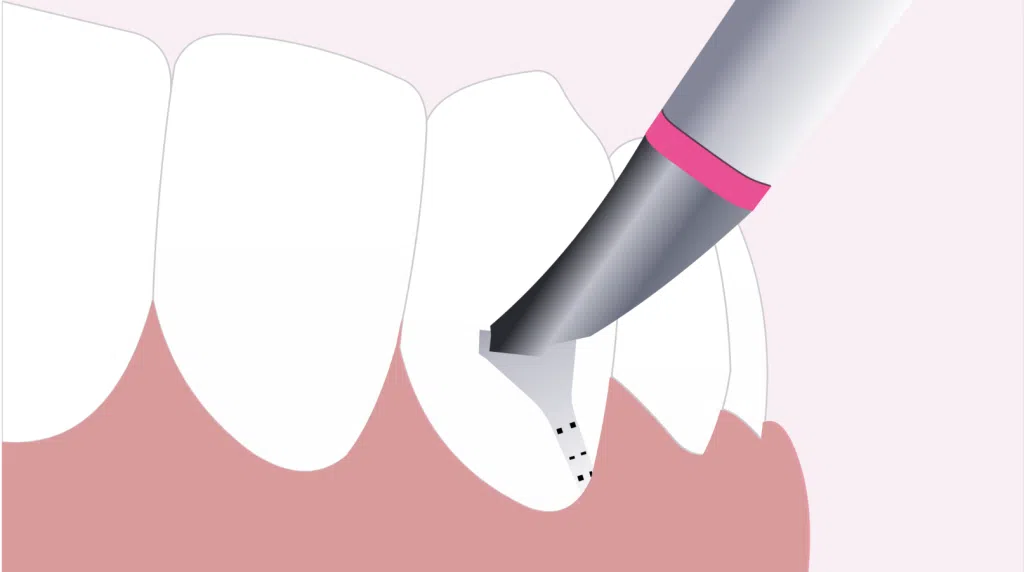 Clinica Dentária - BMQ Clinic | Guided Biofilm Therapy | gbt passo 5