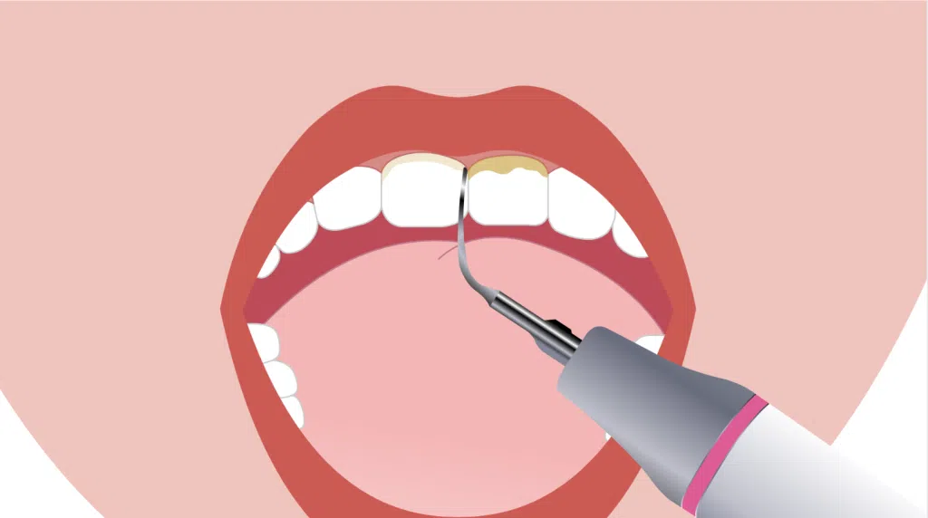 Clinica Dentária - BMQ Clinic | Guided Biofilm Therapy | gbt passo 6